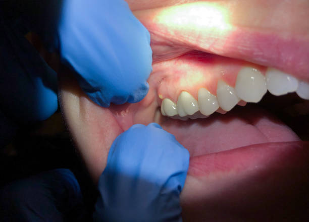 Best Cracked Tooth Emergency Dentist  in Palos Verdes Estates, CA