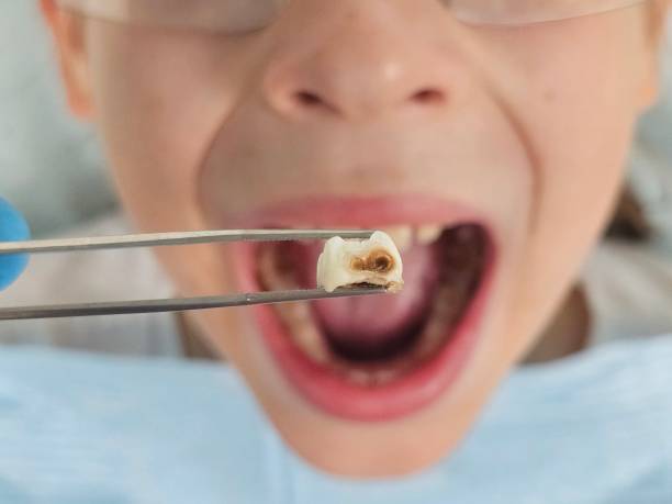Best Broken Tooth Emergency  in Palos Verdes Estates, CA