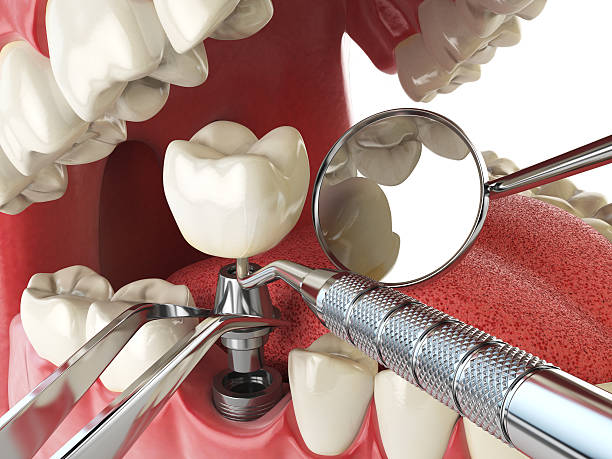 Best Root Canal Emergency Dentist  in Palos Verdes Estates, CA